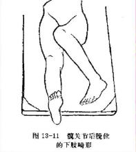 小孩髋关节脱臼复位手法视频,宝宝髋关节脱位可以正骨复位吗