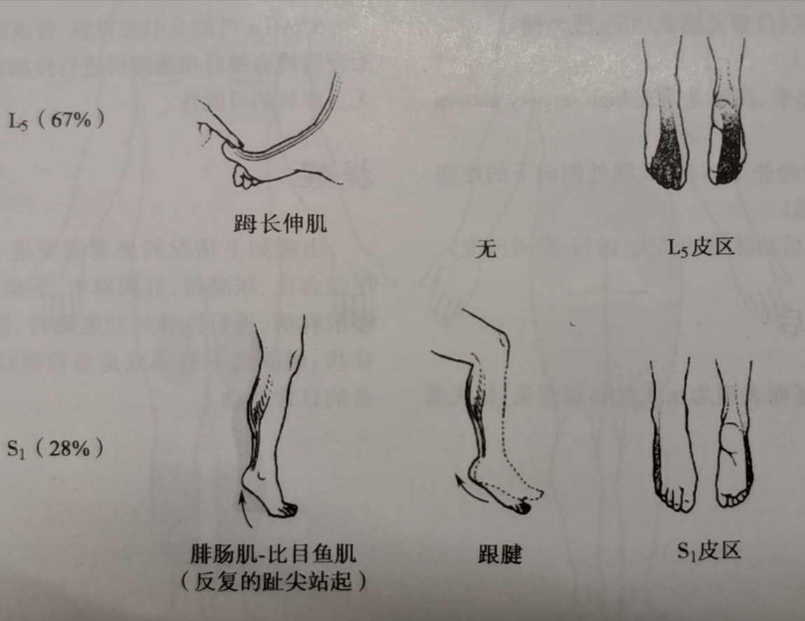 腰间盘突出引起下肢麻木怎么治,腰间盘突出下肢无力走路沉重