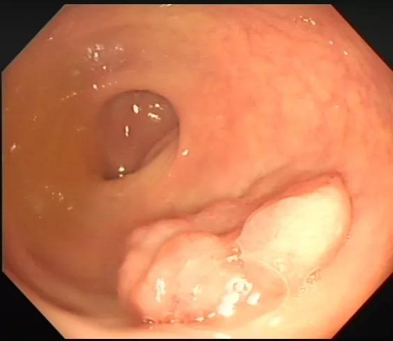 消化内镜发展现状,上消化道超声内镜临床应用