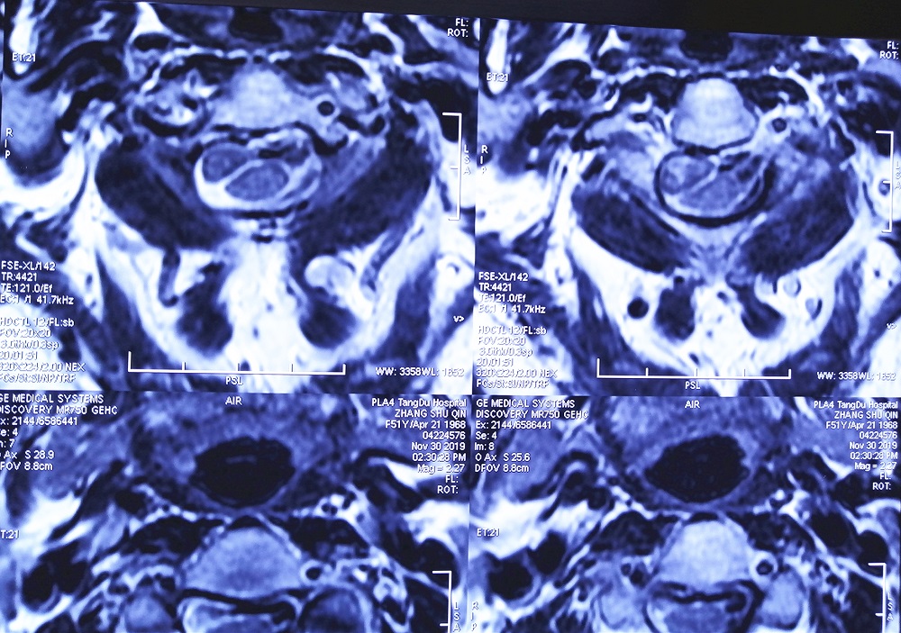 间歇性双手麻木是什么原因和征兆,双手指持续性发麻是什么原因