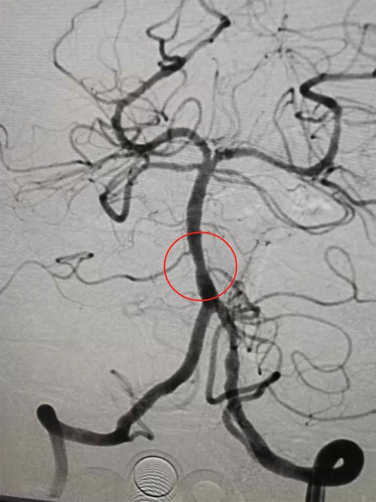 颅内动脉支架成形术，让塌陷的颅内动脉重获新生