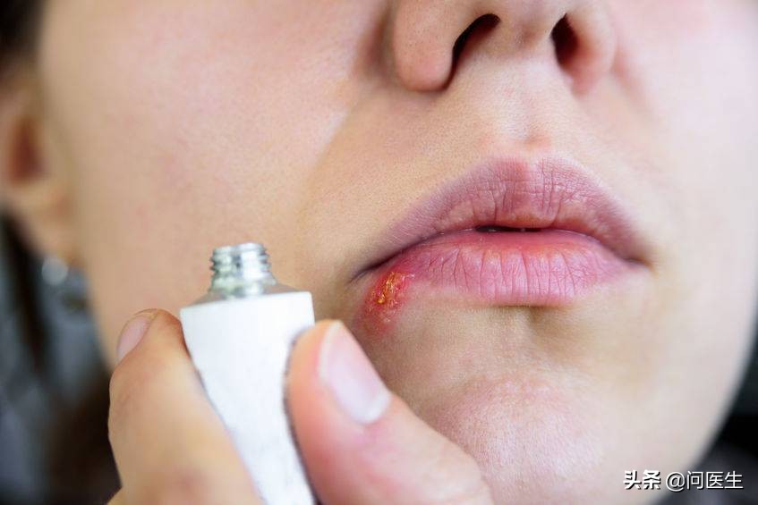 一到换季手上就湿疹,换季过敏皮炎湿疹