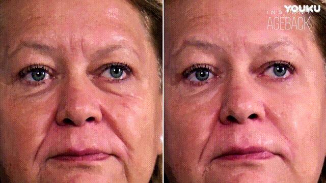 护肤黑科技顶级医美,用黑科技去除眼袋肿了十天