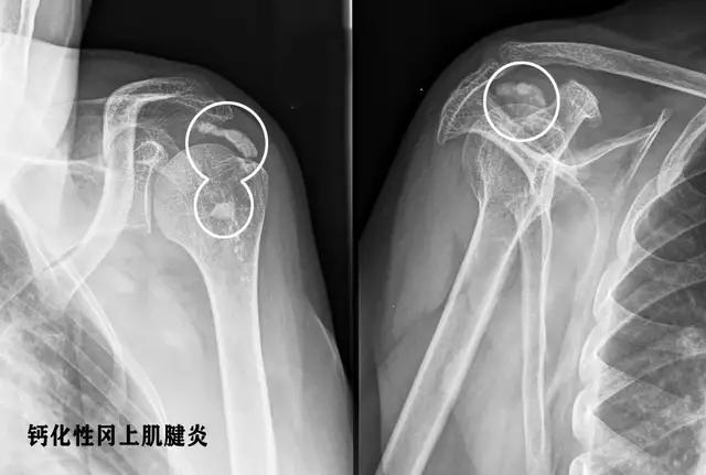 肩膀疼痛竟是如此大问题不可小觑,肩膀疼痛的辨别和解决方法