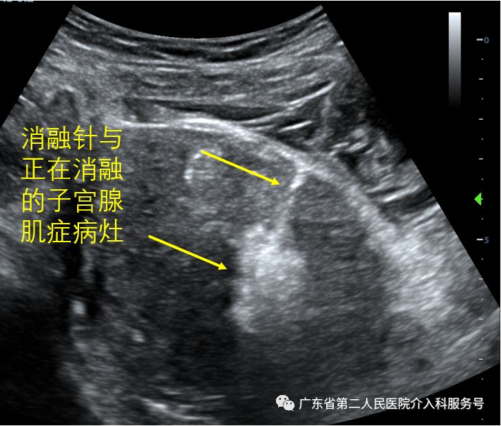 痛经消融手术,痛经微创