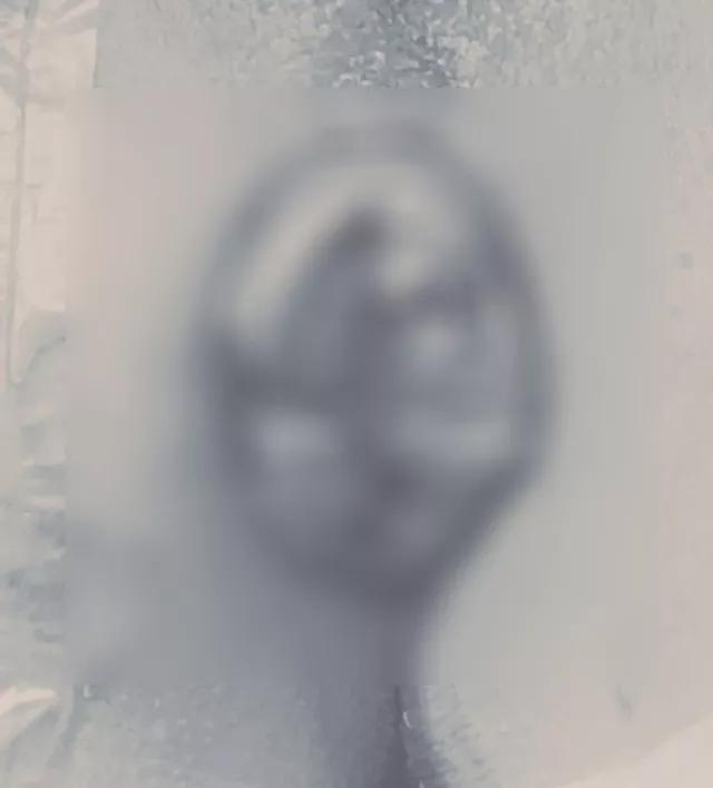 菊花根治肛肠病,菊花有修复术吗