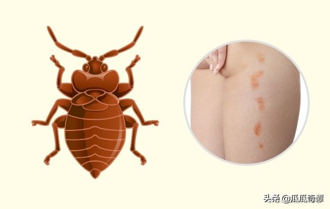 夏季蚊虫叮咬教你一招轻松解决,各种昆虫叮咬清晰图片对照表
