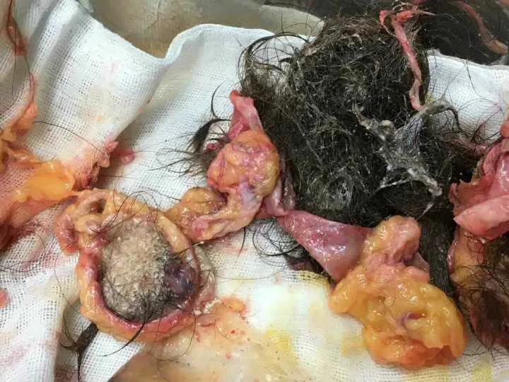 38岁女子盆腔长出了毛发和骨骼，这是一种什么怪病？