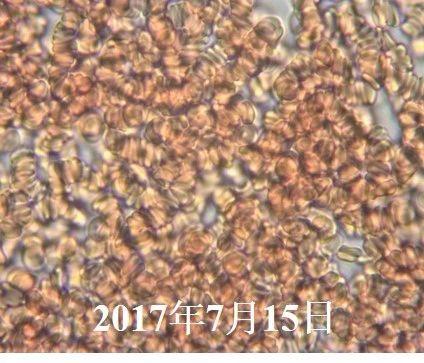 血液粘稠的病因及治疗,健康血液粘稠别小看但也别乱治