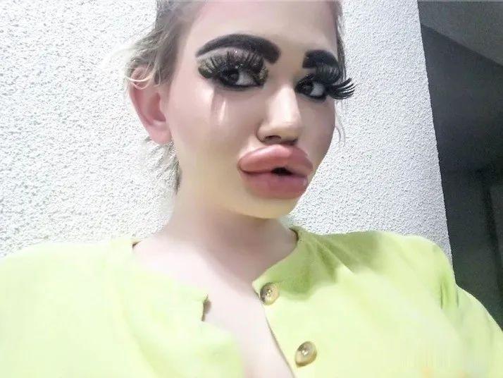 20次整容成功的女人,22岁女人做20次丰唇手术