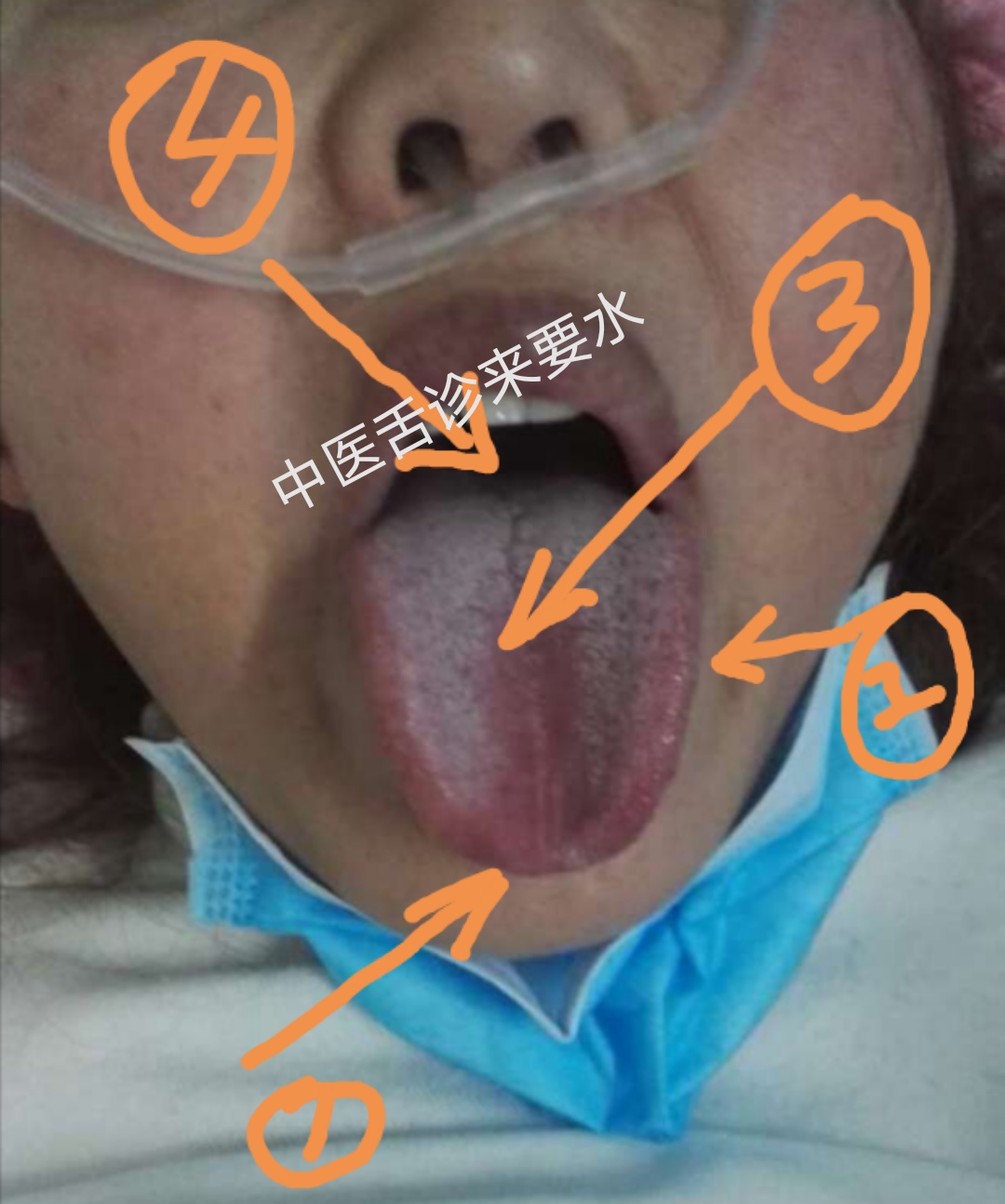 战“疫”当前，胖大舌提示你什么（三）