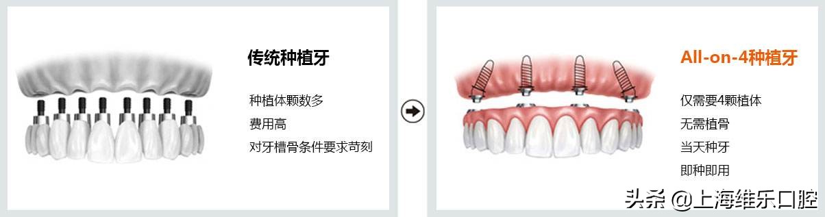 老人缺牙有三种修复方法,老人半口或全口缺牙怎么办