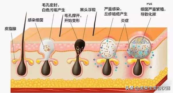 美容院清洁铲黑头仪器真的有用吗,美容院深度清洁皮肤可吸黑头仪器