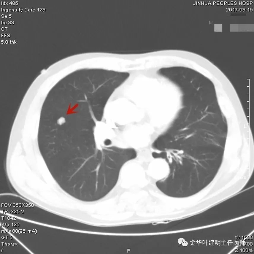 叶建明谈实性结节,叶建明肺实性良性结节会变癌症吗