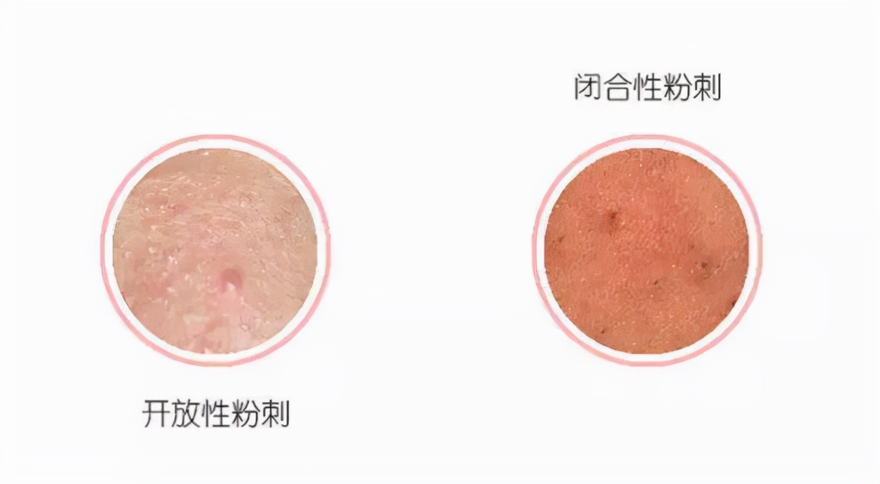 去闭口快速有效的方法,去闭口最有效的方法推荐