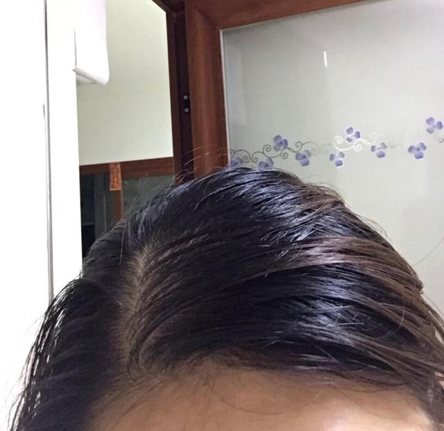 爱出油的头发是不是应该天天洗头,头发太爱油怎么办