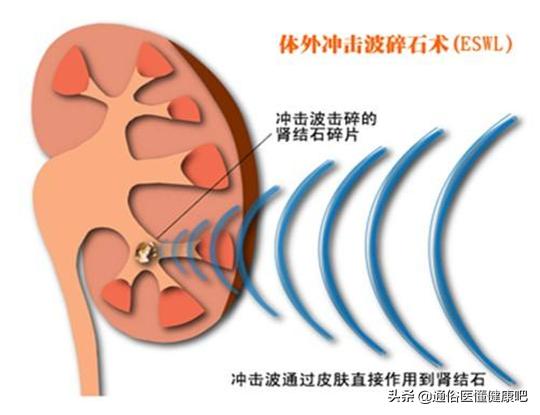 体外碎石冲击波与超声波哪个好,体外冲击波碎石与微创碎石哪个好