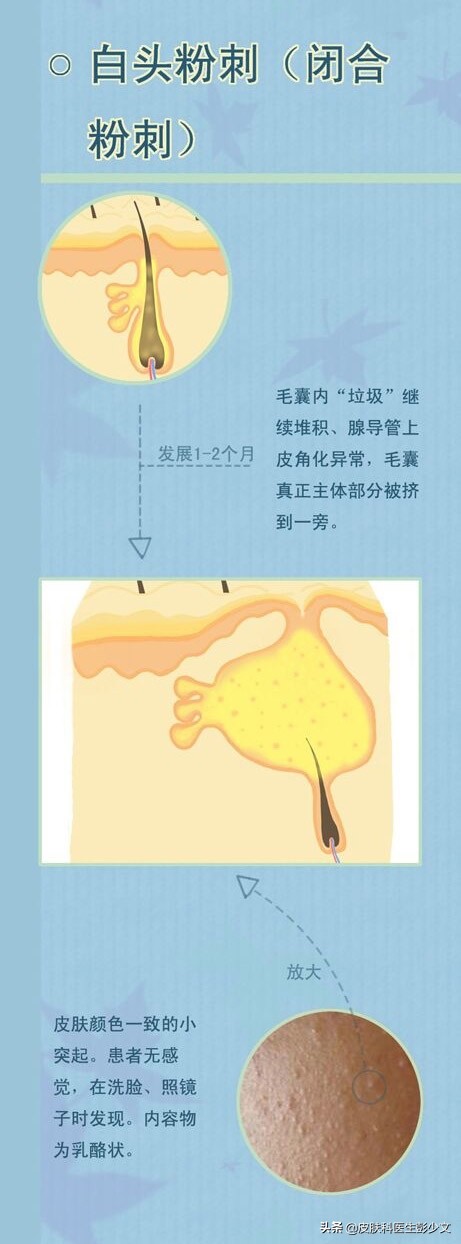 痘疮怎么治疗最快啊,身体长痘长疮怎么办最快消除