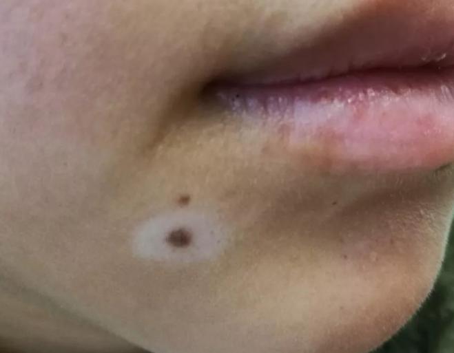 什么是晕痣和白癜风,晕痣型白癜风和白癜风有什么区别