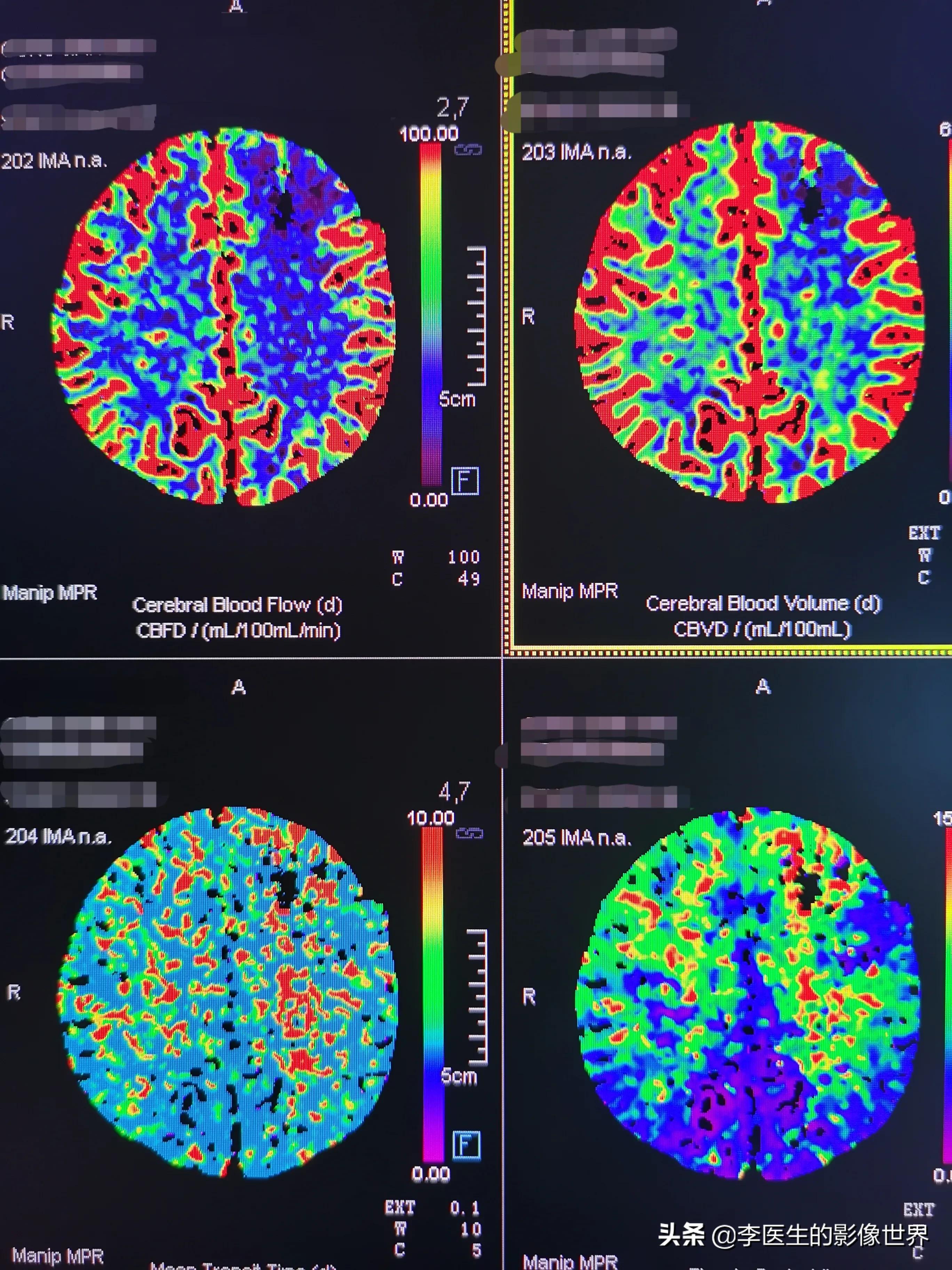 烟雾病灌注视频,烟雾病对脑梗溶栓的风险