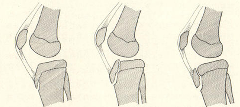 11岁孩子膝盖下方疼是生长痛吗,十四岁孩子膝盖下一点尖骨疼