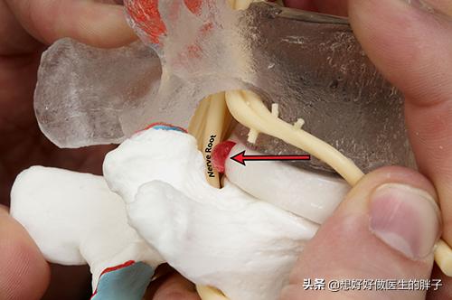 腰椎间盘突出髓核脱出要动手术吗,腰间盘脱出髓核游离能保守治疗吗