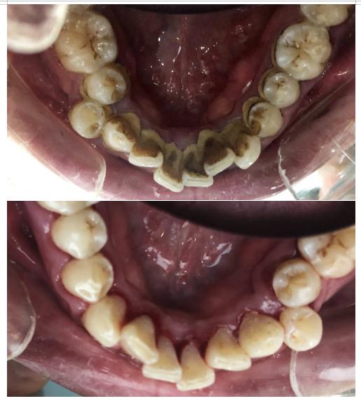 洗牙每年洗一次对牙齿好吗,多久洗一次牙为好洗牙多少钱