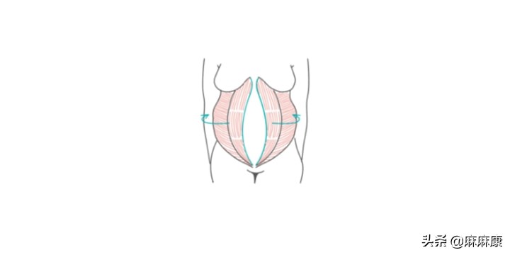 生完孩子躲不过的腹直肌分离，到底要怎么修复？