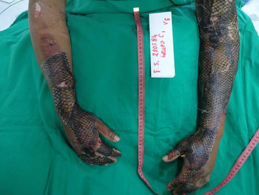 罗非鱼鱼皮治疗烧伤后价值,用罗非鱼鱼皮治疗烧伤