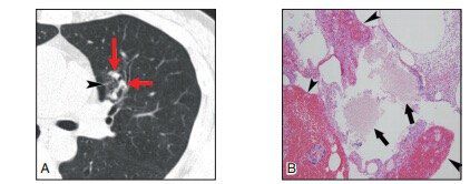 肺CT报告中的肺结节GGO是什么东西？到底是不是癌？