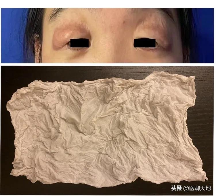 儿童眼睑浮肿要警惕三种病,中医说眼睑水肿