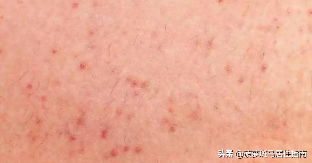 最简单的脱毛大法,推荐5个脱毛方法