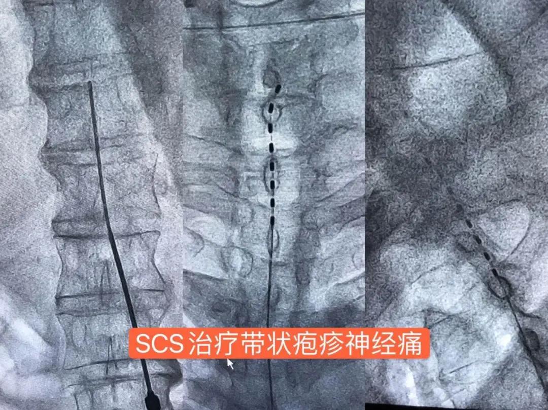 脊髓电刺激治疗带状疱疹手术,带状疱疹脊髓电刺激植入术