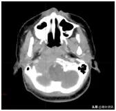 放疗不独用于癌症，治疗良性病也有奇效