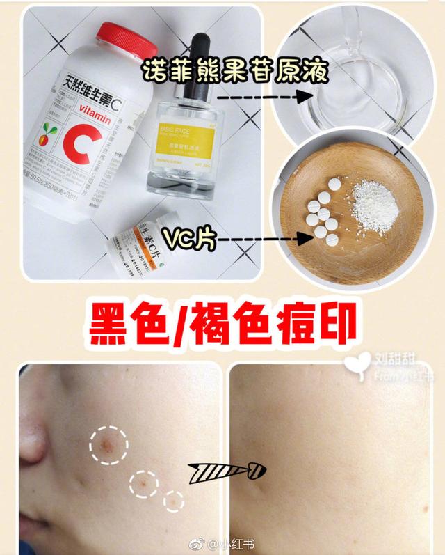 身上的痘痘跟痘印该怎么去除,祛除痘痘和痘印最快方法