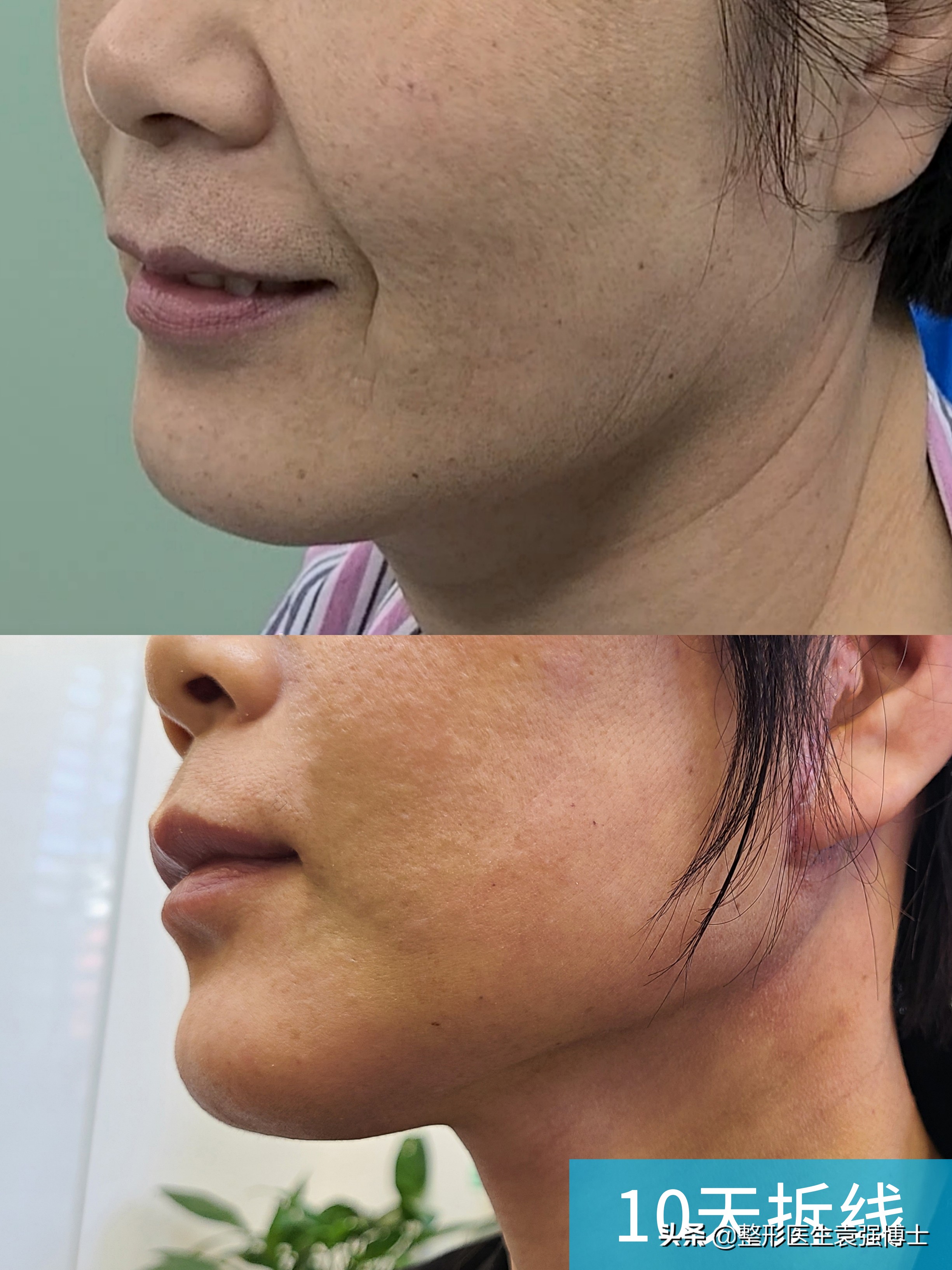 45岁的女人做侧拉皮,48岁做拉皮手术亲身经历