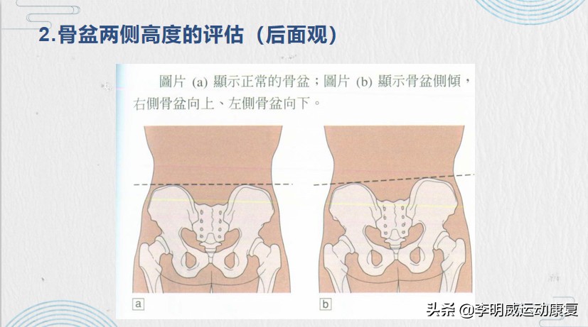 骨盆侧倾的治疗方法,骨盆侧倾最佳的矫正方法