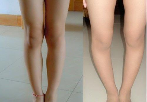 孩子o型腿可以自己绑腿吗,新生儿可以通过绑腿预防o型腿吗