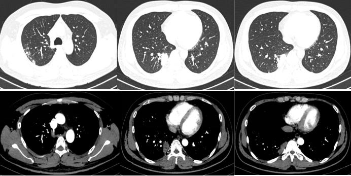肺部陈旧病灶会变大么,肺部病灶1.2厘米严重吗