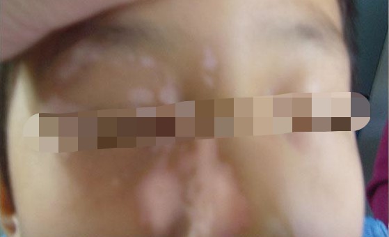 小孩怎么区分白斑和白癜风,如何辨别白斑和白癜风区别