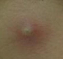 痈疮肿毒中医外治,中医治疗痈疮的方法