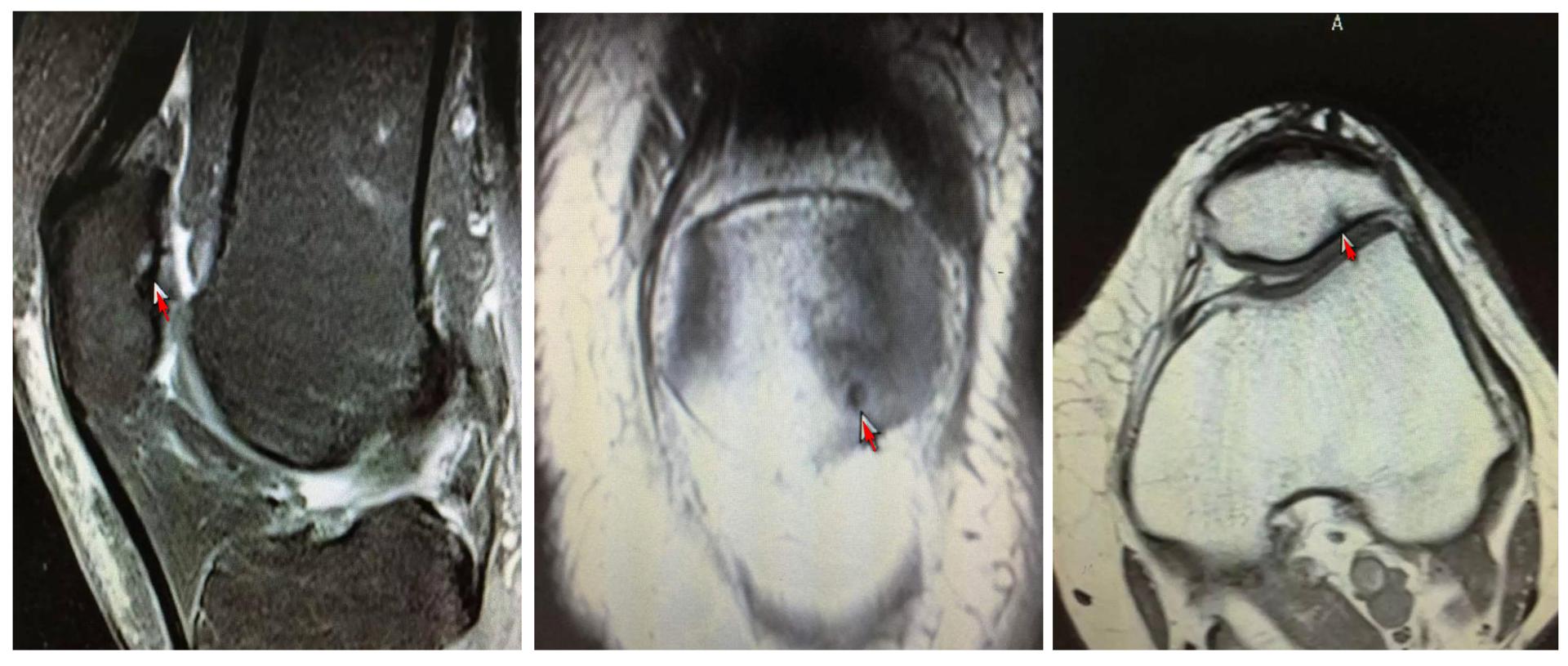 膝盖附近疼是髌骨软化症引起的吗,髌骨膝前疼痛综合症