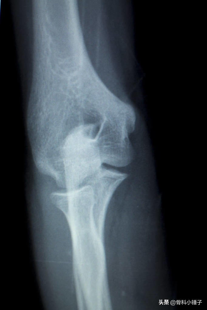 网球肘痛了半年了怎么治疗最好,网球肘疼痛解决最好办法