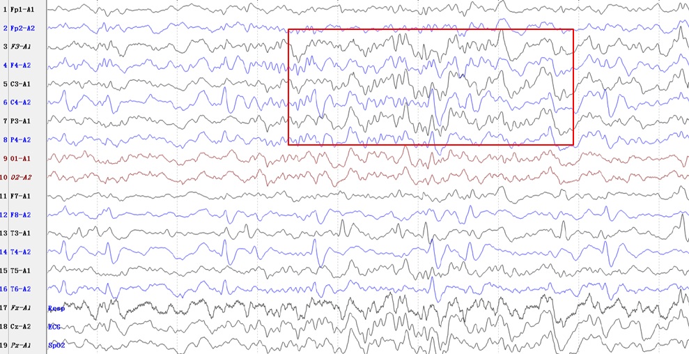 抑郁患者如何读懂脑电图,如何读懂脑电图监测报告