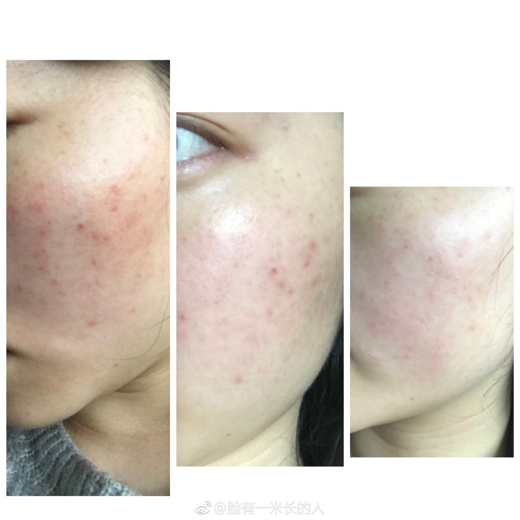 十天淡化痘印的小妙招,3天快速淡化痘印药膏