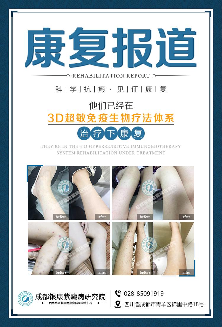 成都西南紫癜研究所,过敏性紫癜医院推荐成都银康