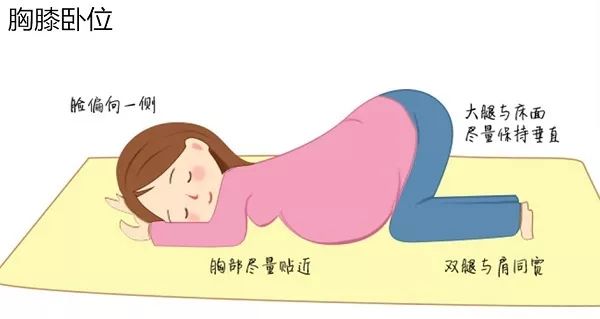 臀位想顺产怎么办,头臀位双胞胎顺产