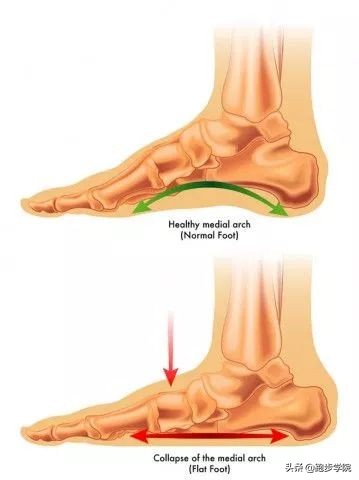 跟腱炎发病处理,跟腱炎如何治疗才能恢复