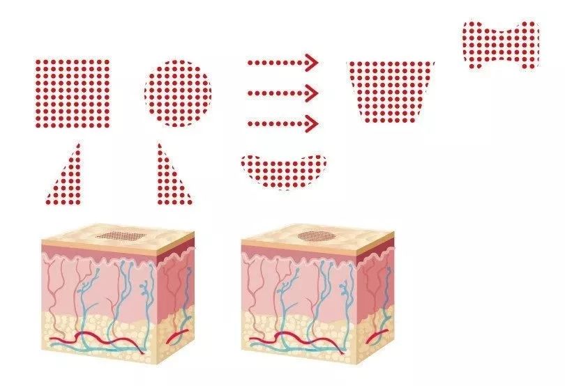 点阵激光治疗凹陷疤痕有用吗,什么是点阵激光