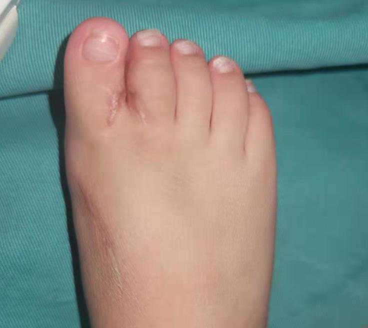 并指畸形免植皮案例,并指畸形